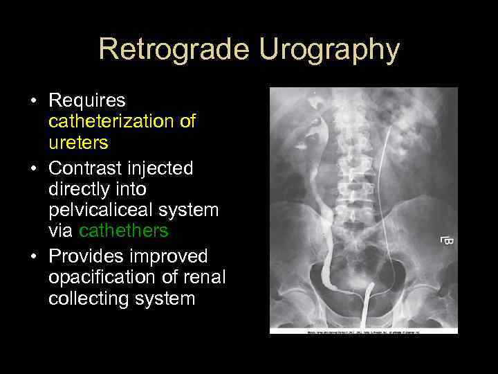 Retrograde Urography • Requires catheterization of ureters • Contrast injected directly into pelvicaliceal system