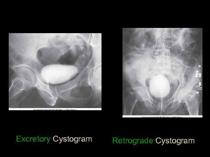 Excretory Cystogram Retrograde Cystogram 