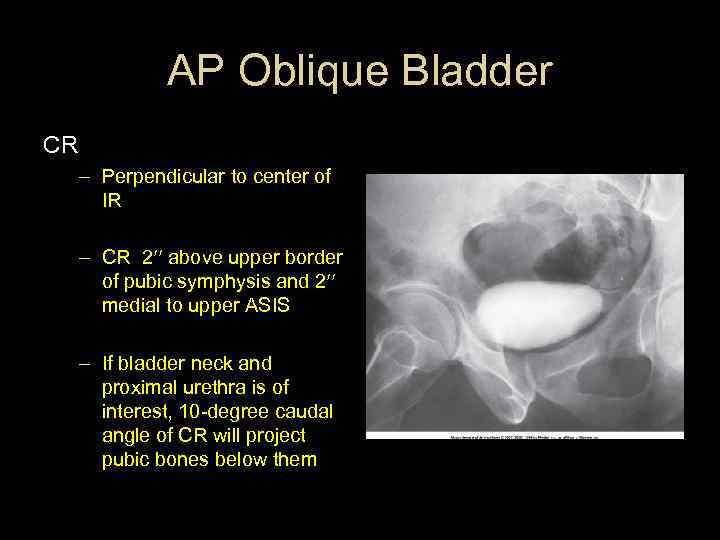 AP Oblique Bladder CR – Perpendicular to center of IR – CR 2 above