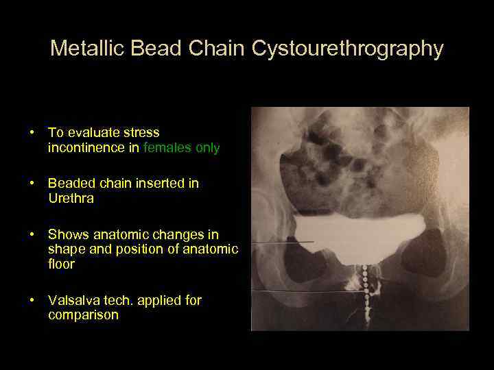 Metallic Bead Chain Cystourethrography • To evaluate stress incontinence in females only • Beaded