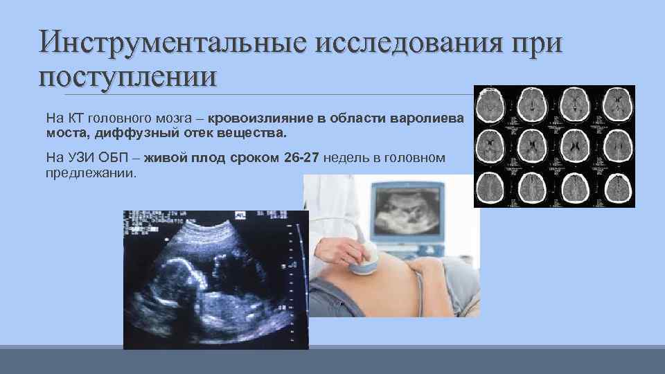 Инструментальные исследования при поступлении На КТ головного мозга – кровоизлияние в области варолиева моста,