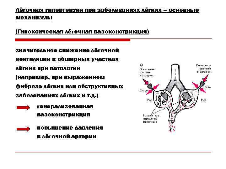 Лёгочная гипертензия при заболеваниях лёгких – основные механизмы (Гипоксическая лёгочная вазоконстрикция) значительное снижение лёгочной