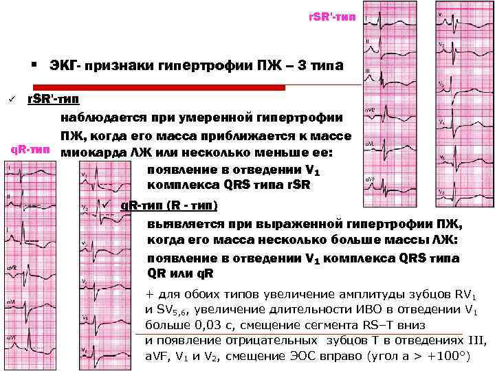 Типы экг. С Тип ЭКГ. Признаки легочной гипертензии на ЭКГ. RSR Тип ЭКГ. R И S Тип ЭКГ.