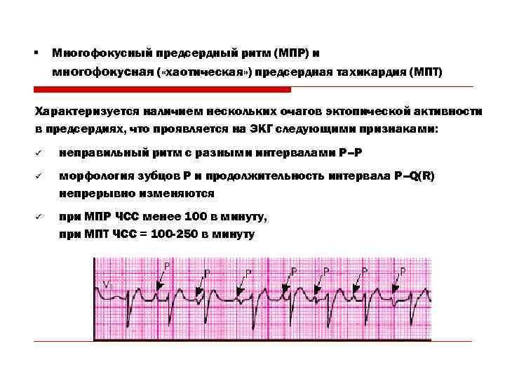 § Многофокусный предсердный ритм (МПР) и многофокусная ( «хаотическая» ) предсердная тахикардия (МПТ) Характеризуется