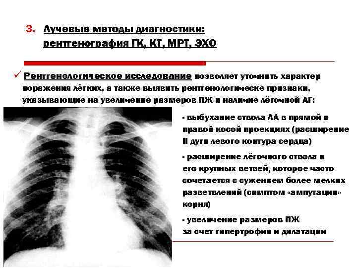 3. Лучевые методы диагностики: рентгенография ГК, КТ, МРТ, ЭХО ü Рентгенологическое исследование позволяет уточнить