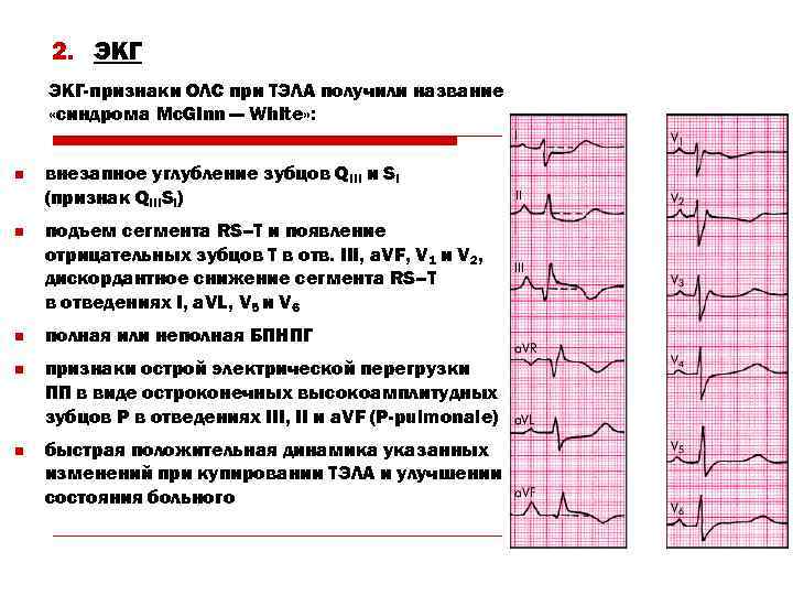 2. ЭКГ-признаки ОЛС при ТЭЛА получили название «синдрома Mc. Ginn — White» : n