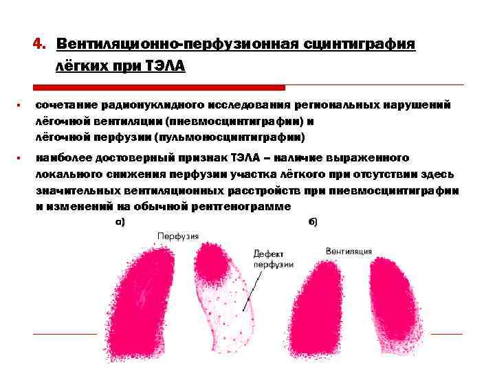 4. Вентиляционно-перфузионная сцинтиграфия лёгких при ТЭЛА § сочетание радионуклидного исследования региональных нарушений лёгочной вентиляции