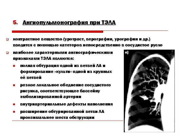 5. Ангиопульмонография при ТЭЛА q контрастное вещество (уротраст, верографин, урографин и др. ) вводится