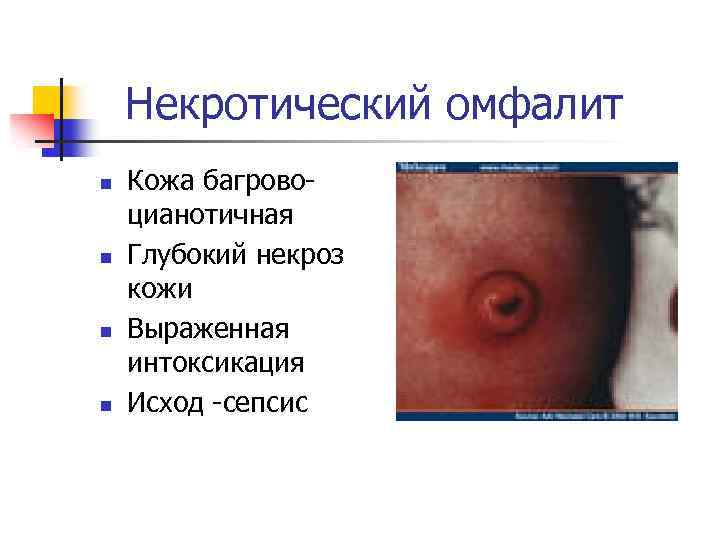 Некротический омфалит n n Кожа багровоцианотичная Глубокий некроз кожи Выраженная интоксикация Исход -сепсис 