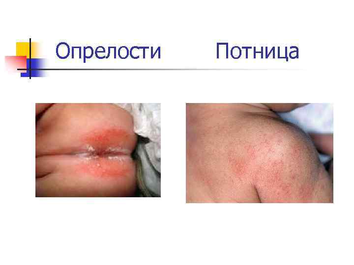 Опрелости Потница 