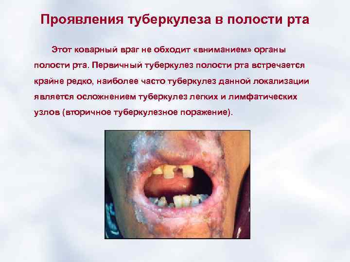 Проявления туберкулеза в полости рта Этот коварный враг не обходит «вниманием» органы полости рта.