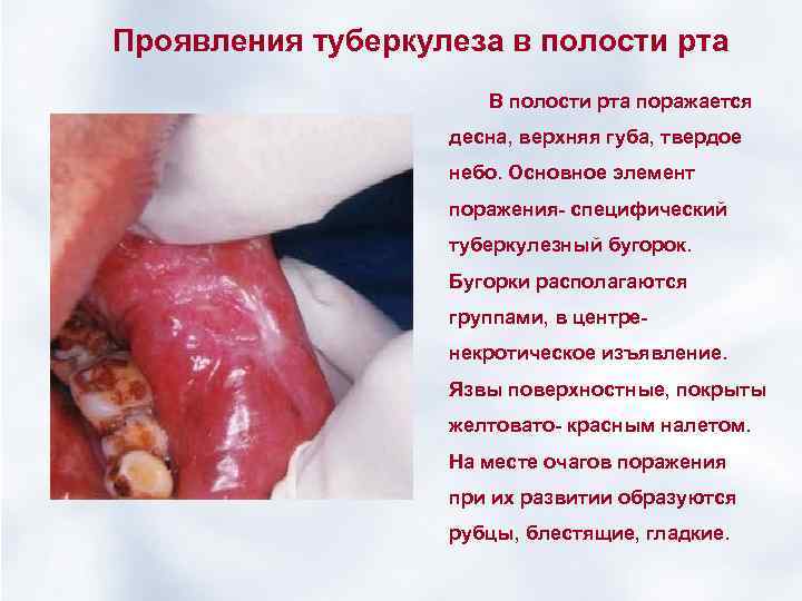 Проявления туберкулеза в полости рта В полости рта поражается десна, верхняя губа, твердое небо.