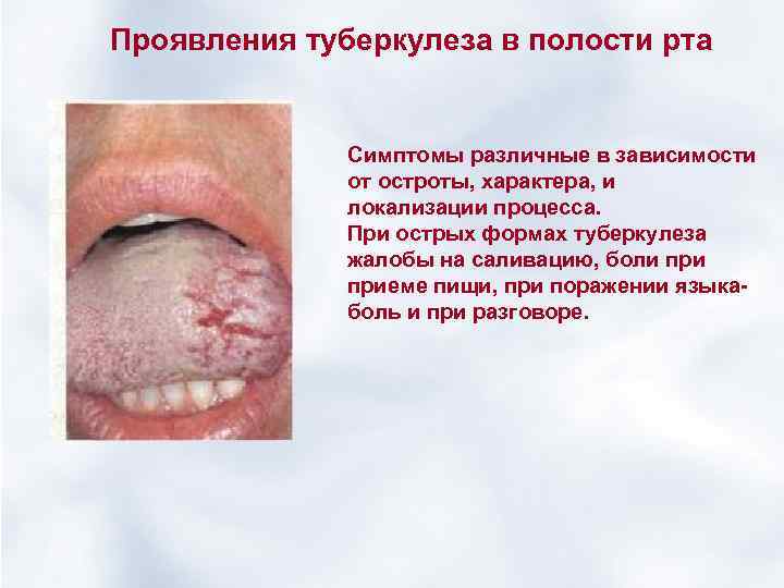 Проявления туберкулеза в полости рта Симптомы различные в зависимости от остроты, характера, и локализации