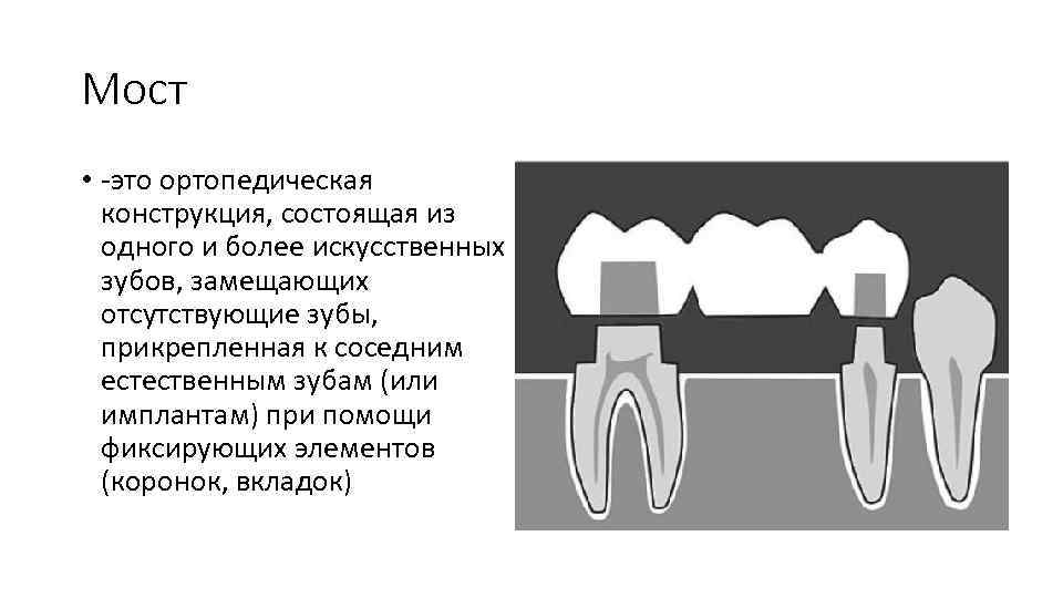 Вкладки ортопедическая стоматология презентация