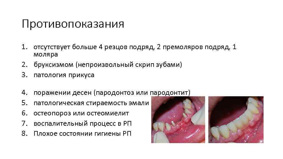 Противопоказания 1. отсутствует больше 4 резцов подряд, 2 премоляров подряд, 1 моляра 2. бруксизмом