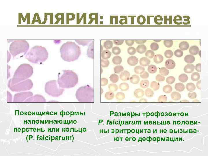МАЛЯРИЯ: патогенез Покоящиеся формы напоминающие перстень или кольцо (Р. falciparum) Размеры трофозоитов Р. falciparum