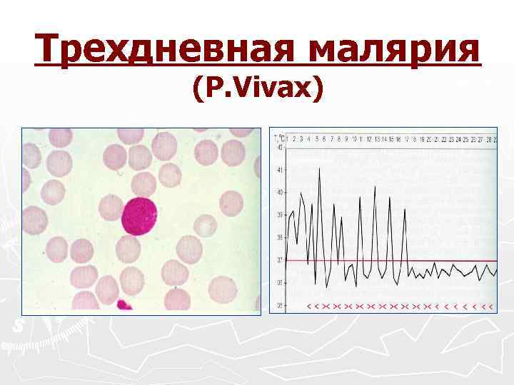 Трехдневная малярия (P. Vivax) 