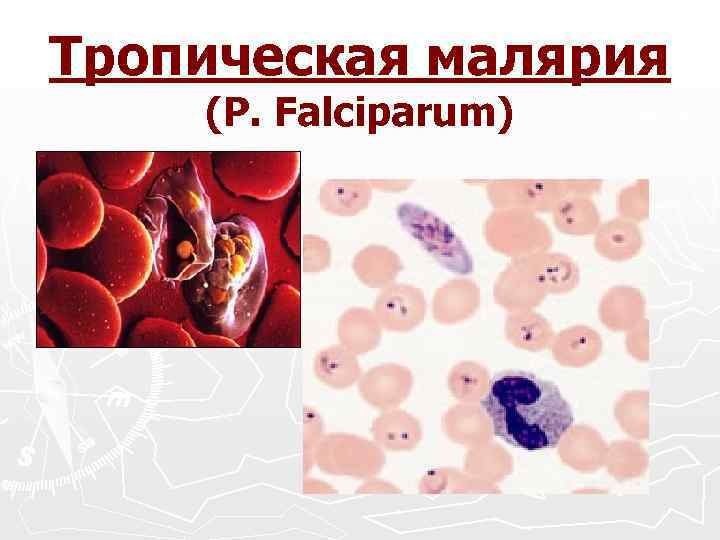 Тропическая малярия (P. Falciparum) 