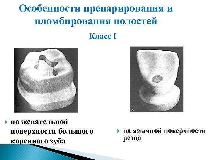Особенности препарирования и пломбирования полостей Класс I на жевательной поверхности большого коренного зуба на