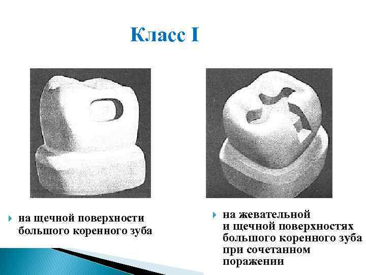 Класс I на щечной поверхности большого коренного зуба на жевательной и щечной поверхностях большого