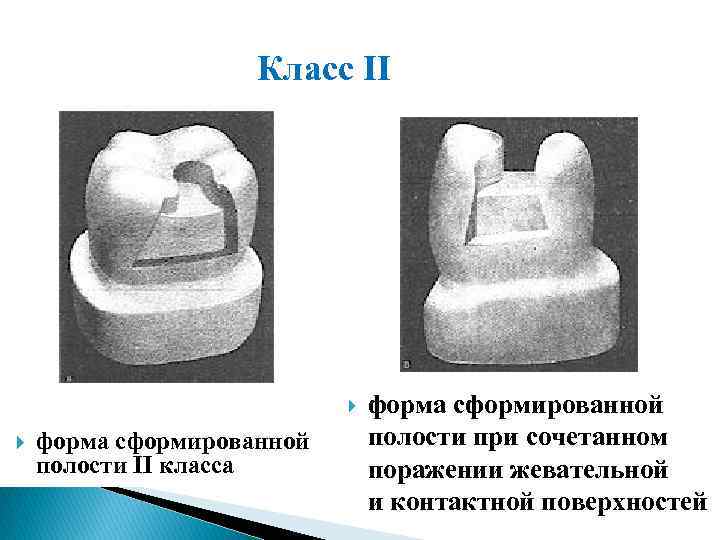 Класс II форма сформированной полости II класса форма сформированной полости при сочетанном поражении жевательной