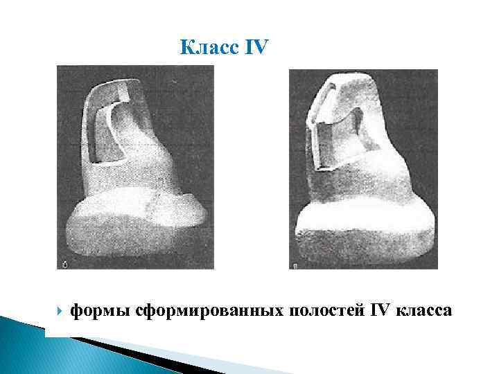 Класс IV формы сформированных полостей IV класса 