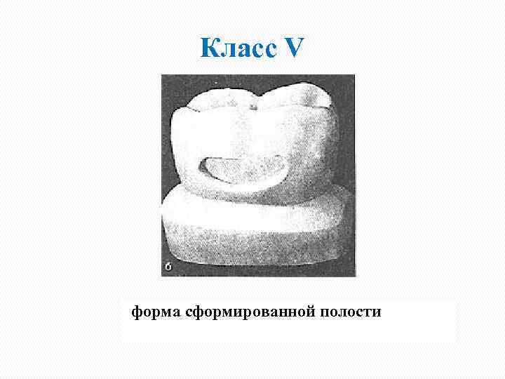 Класс V форма сформированной полости 