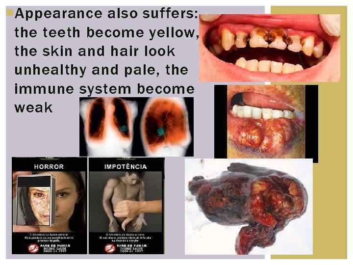  Appearance also suffers: the teeth become yellow, the skin and hair look unhealthy