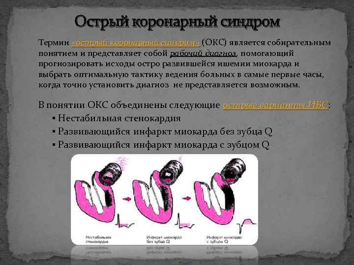 Острый коронарный синдром Термин «острый коронарный синдром» (ОКС) является собирательным понятием и представляет собой