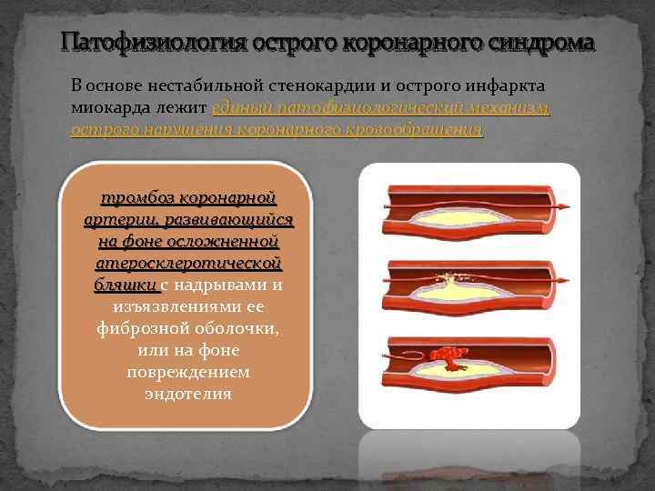 Патофизиология острого коронарного синдрома В основе нестабильной стенокардии и острого инфаркта миокарда лежит единый