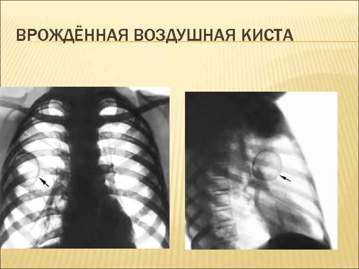 ВРОЖДЁННАЯ ВОЗДУШНАЯ КИСТА 