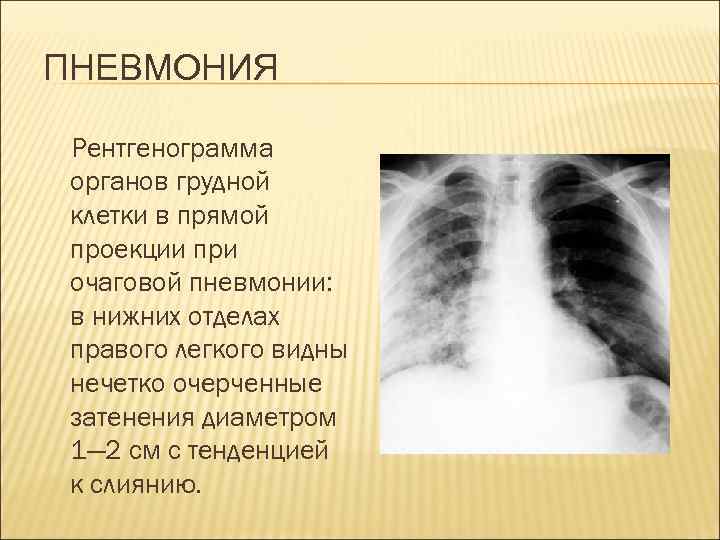ПНЕВМОНИЯ Рентгенограмма органов грудной клетки в прямой проекции при очаговой пневмонии: в нижних отделах