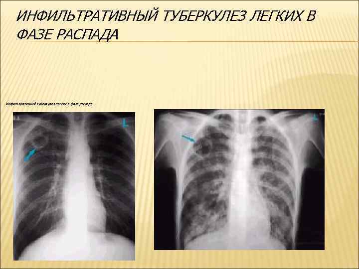 ИНФИЛЬТРАТИВНЫЙ ТУБЕРКУЛЕЗ ЛЕГКИХ В ФАЗЕ РАСПАДА . Инфильтративный туберкулез легких в фазе распада 