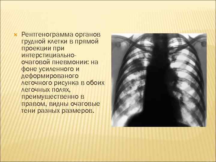  Рентгенограмма органов грудной клетки в прямой проекции при интерстициальноочаговой пневмонии: на фоне усиленного