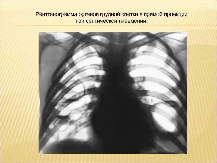 Рентгенограмма органов грудной клетки в прямой проекции при септической пневмонии. 