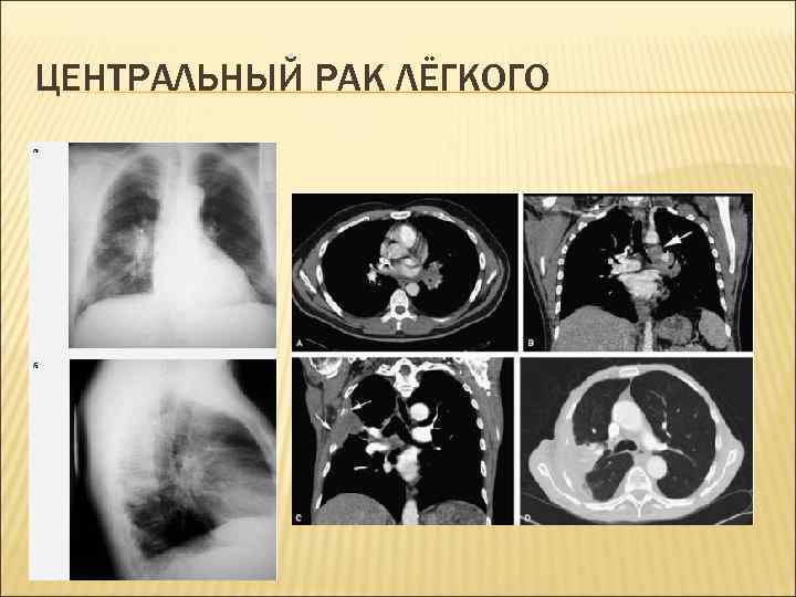  ЦЕНТРАЛЬНЫЙ РАК ЛЁГКОГО 