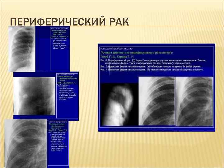 ПЕРИФЕРИЧЕСКИЙ РАК 