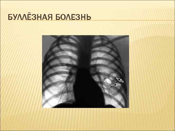 БУЛЛЁЗНАЯ БОЛЕЗНЬ 