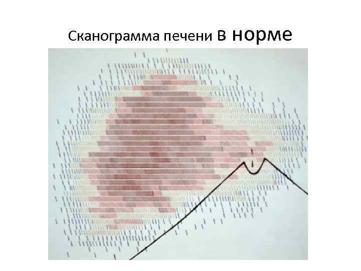 Сканограмма печени в норме 