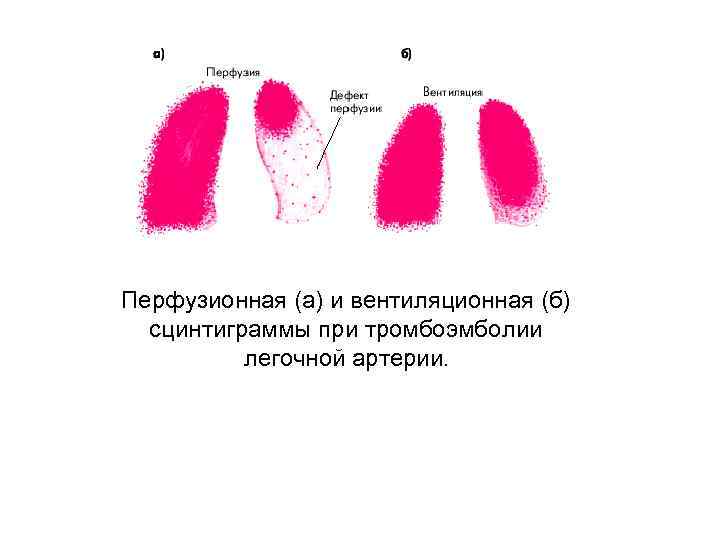Перфузионная (а) и вентиляционная (б) сцинтиграммы при тромбоэмболии легочной артерии. 