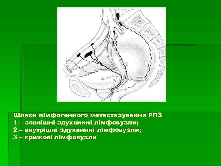 Шляхи лімфогенного метастазування РПЗ 1 – зовнішні здухвинні лімфовузли; 2 – внутрішні здухвинні лімфовузли;