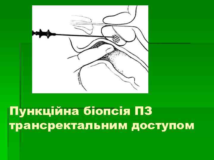 Пункційна біопсія ПЗ трансректальним доступом 