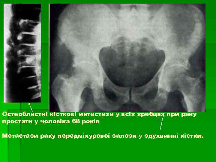 Остеобластні кісткові метастази у всіх хребцях при раку простати у чоловіка 68 років Метастази