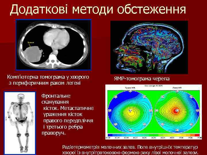 Додаткові методи обстеження Комп’ютерна томограма у хворого з периферичним раком легені ЯМР-томограма черепа Фронтальне