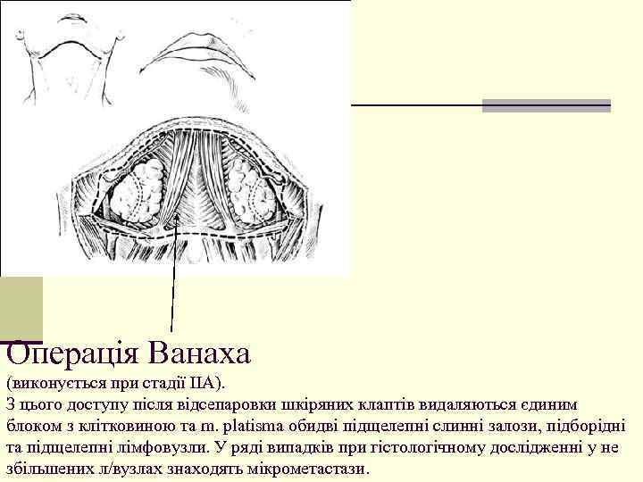 Операція Ванаха (виконується при стадії ІІА). З цього доступу після відсепаровки шкіряних клаптів видаляються