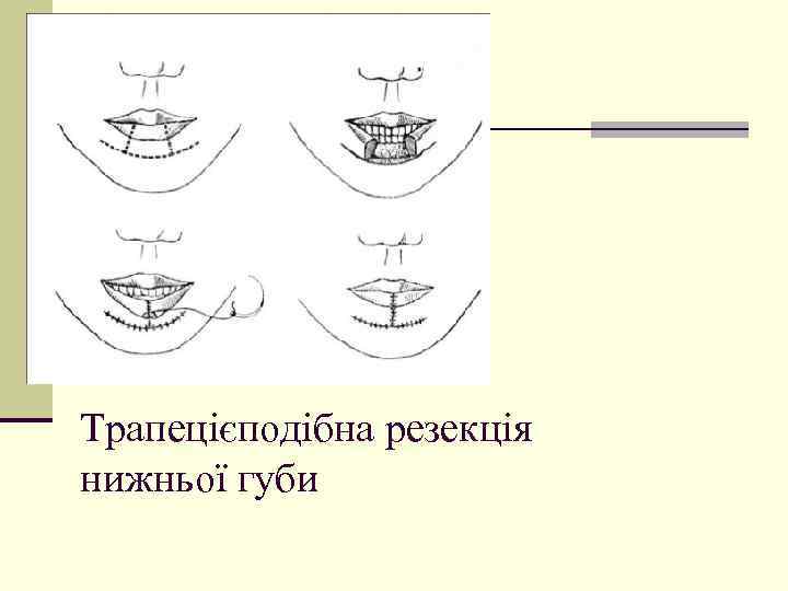 Трапецієподібна резекція нижньої губи 