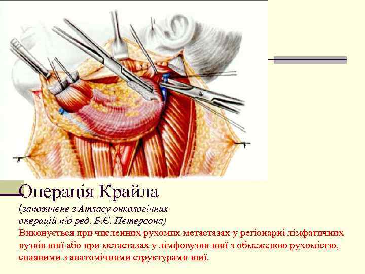 Операція Крайла (запозичене з Атласу онкологічних операцій під ред. Б. Є. Петерсона) Виконується при