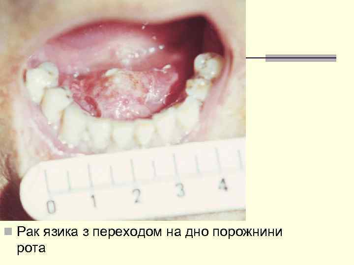 n Рак язика з переходом на дно порожнини рота 