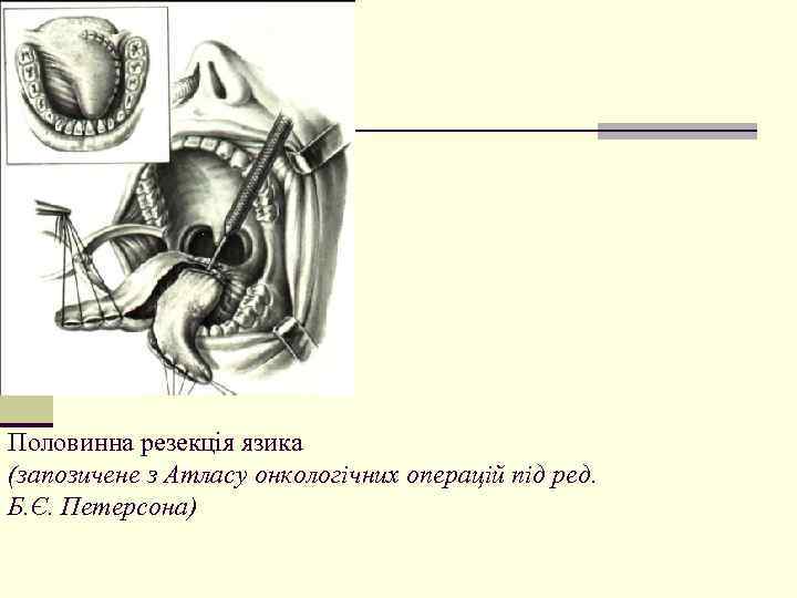 Половинна резекція язика (запозичене з Атласу онкологічних операцій під ред. Б. Є. Петерсона) 