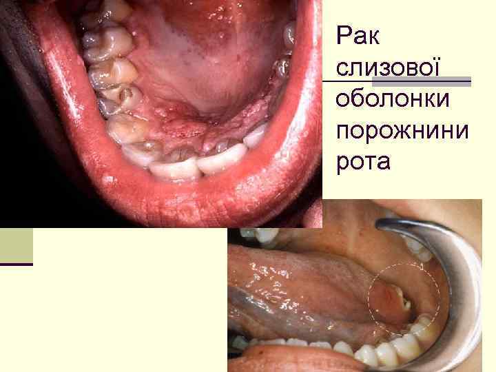 Рак слизової оболонки порожнини рота 